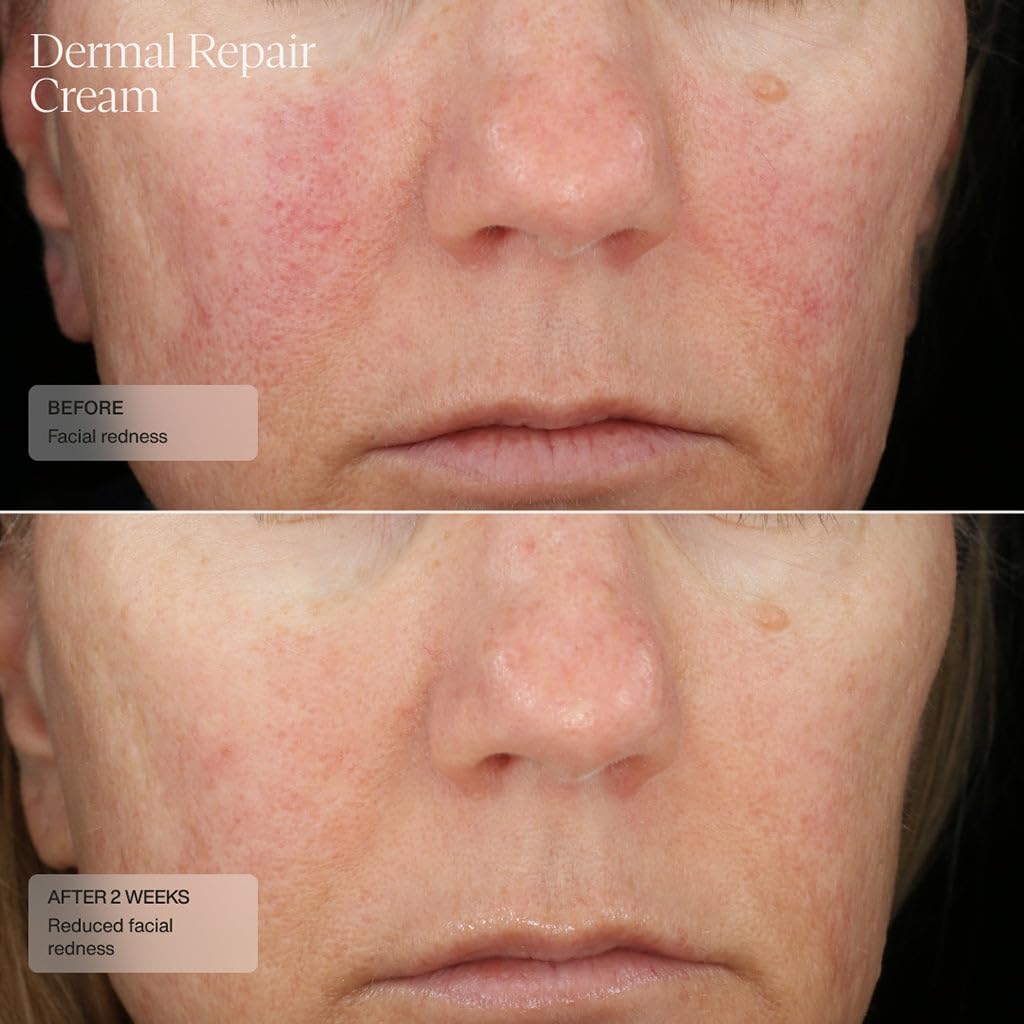 Senté Dermal Repair Facial Cream | Nourishing for Rosacea & Sensitive Skin | Hydrate & Rejuvenate | with Patented HSA, Vitamin E & Green Tea Extract - 1.7 Fl Oz