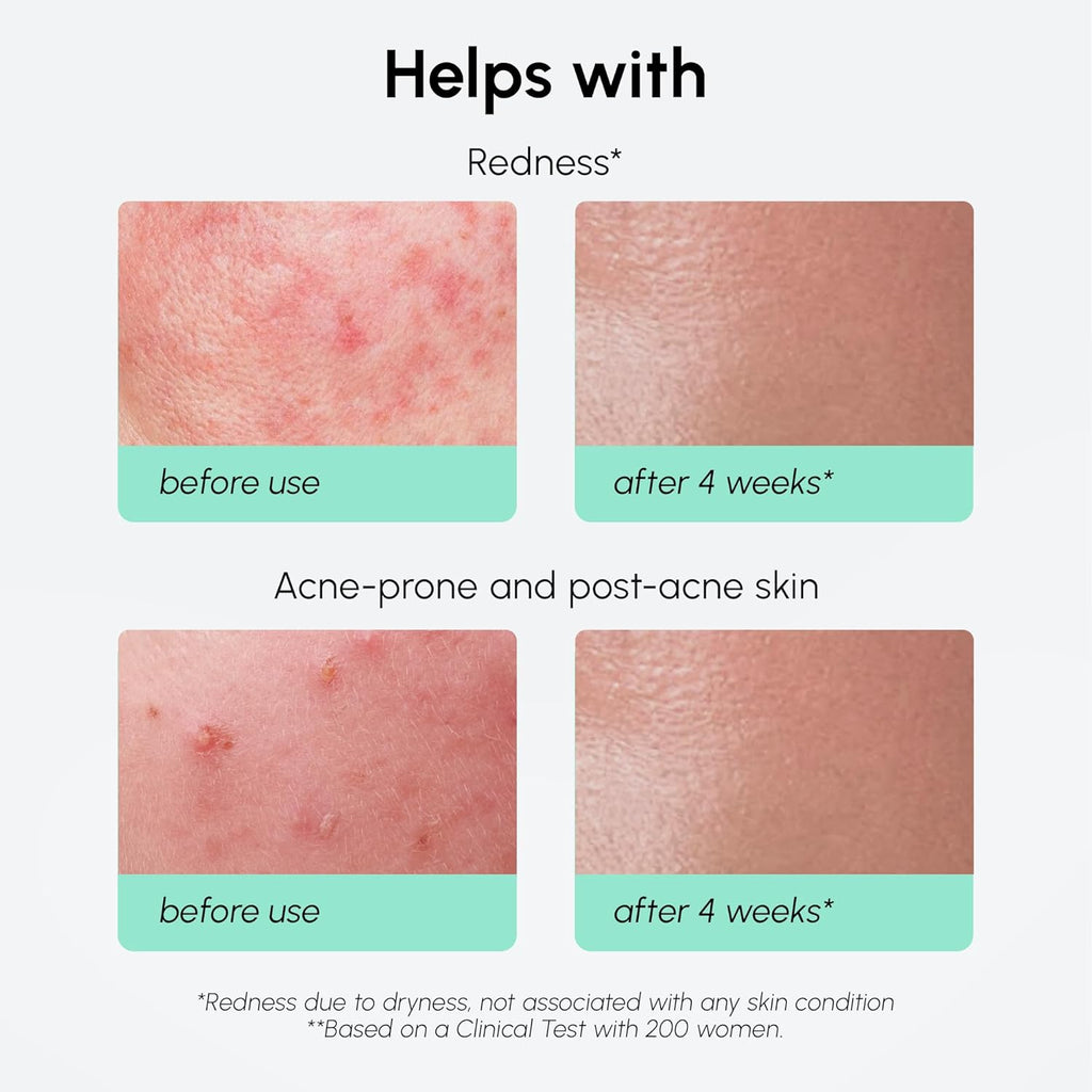 MAREE 10% Azelaic Acid Face Serum - Redness Soothing Hydrating Serum with Niacinamide, Centella Asiatica & Hyaluronic Acid - Relief Serums for Face & Body - Azalecic Acid Skin Facial - Acido Azelaico