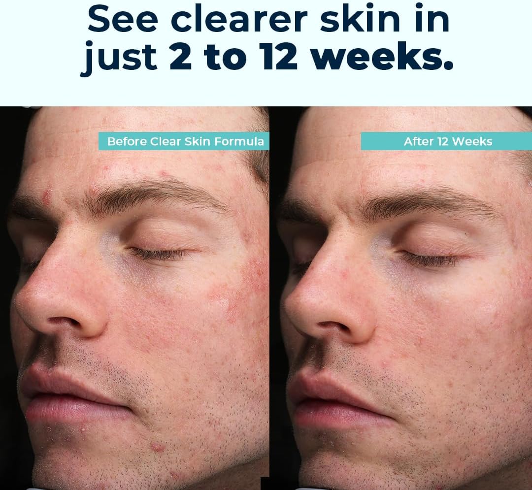 VitaMedica Clear Skin Vitamin Formula | Noncystic Acne Supplement for Skin Clearing | Breakout Treatment for Women and Men | Vitamins A, C, E, Selenium, Chromium, and Zinc for Skin Health | 2 Pack