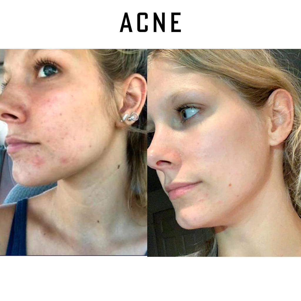 Pure Organic Ozonated Olive Oil 600 Peroxide For Face and Skin Helps In Acne, Anti-Aging, Wrinkles and All Skin Problems For Sensitive Skin with Made in Spain