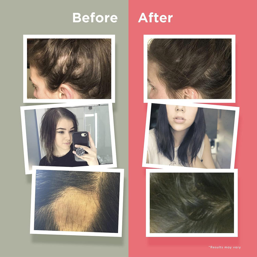 HairAnew Hair Growth Vitamins for Thicker Stronger Hair | Works for Women & Men All Hair Types | 11 Hair Vitamins & Ingredients | 5000mcg Biotin | Vegan | Independently Tested | 60 Capsules (3)
