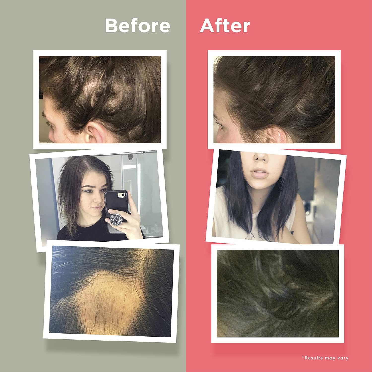 HairAnew Hair Growth Vitamins for Thicker Stronger Hair | Works for Women & Men All Hair Types | 11 Hair Vitamins & Ingredients | 5000mcg Biotin | Vegan | Independently Tested | 60 Capsules (3)