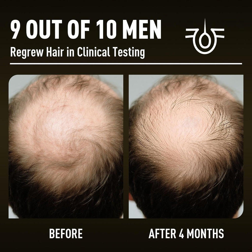 Minoxidil Hair Growth with Biotin 5%: Minoxidil for Men and Women - Hair Growth Supports Thicker and Fuller Beard & Hair(2 Pack 4Oz for 4 Month Supply)