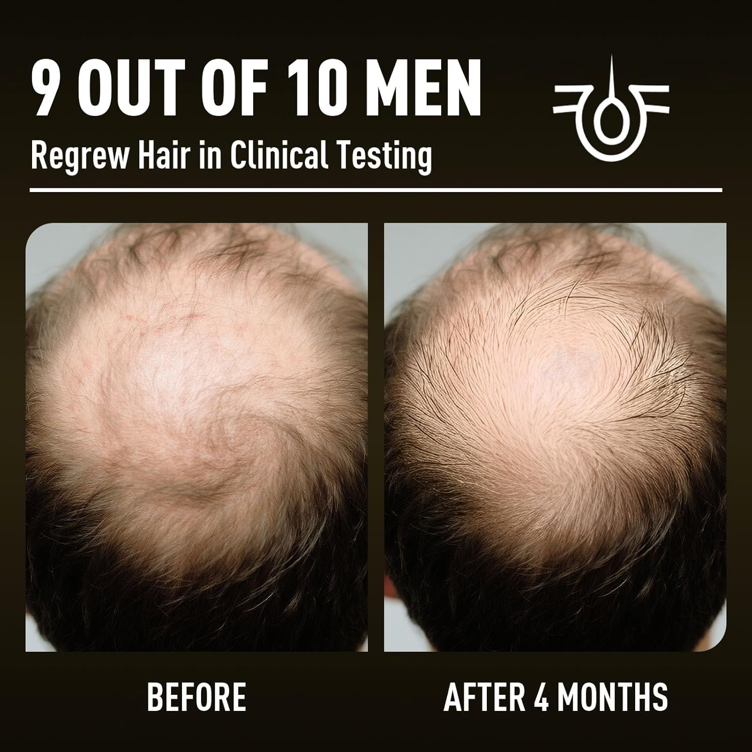 Minoxidil Hair Growth with Biotin 5%: Minoxidil for Men and Women - Hair Growth Supports Thicker and Fuller Beard & Hair(2 Pack 4Oz for 4 Month Supply)
