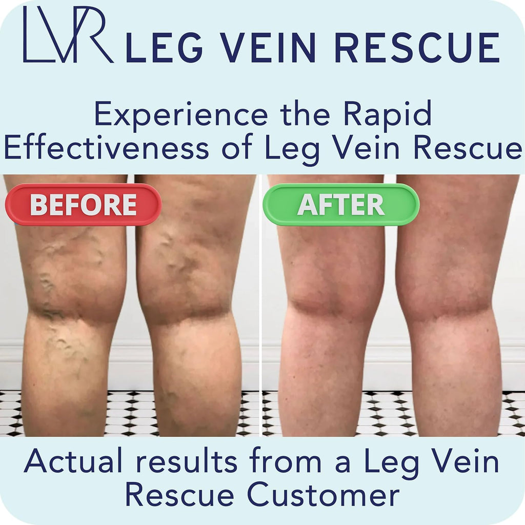 Clinically Studied Diosmin Varicose Vein and Leg Circulation Support 90 Day Supply - Spider Veins & Leg Edema Relief Citrus Bioflavonoids Natural Health Supplement (90 Capsules)