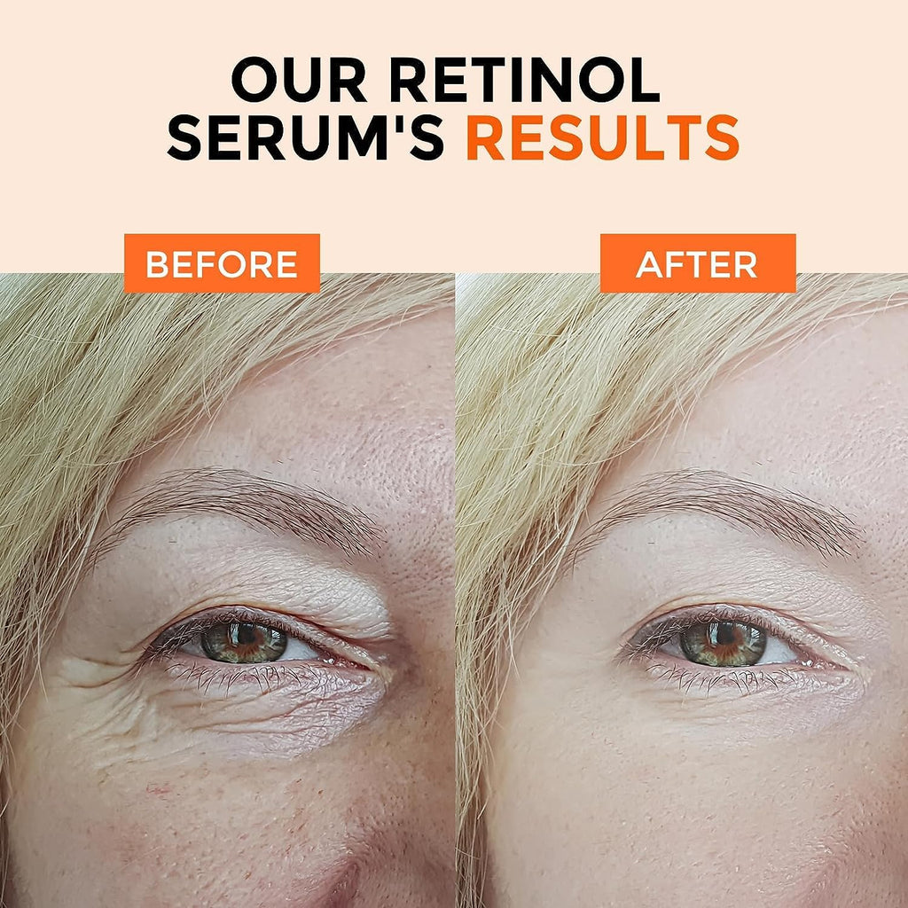 Face Serum Set – Retinol Serum & Hyaluronic Acid for Face – Anti Aging Skin Care Set for Women – Firm, Wrinkle Smoothing