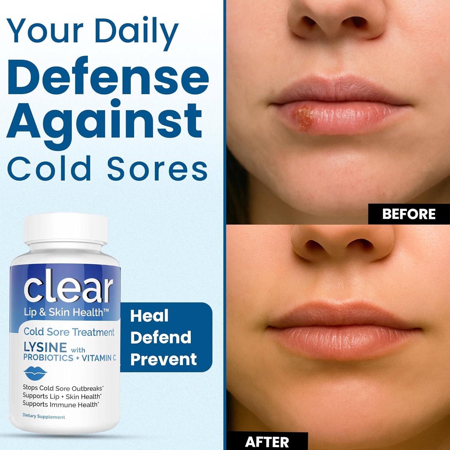 Lysine Cold Sore Treatment for Lips – with Lactobacillus Rhamnosus, Acidophilus and Vitamin C – Cold Sore Supplement for Lip & Skin Health, Immune Support & Prevention – 180 Capsules