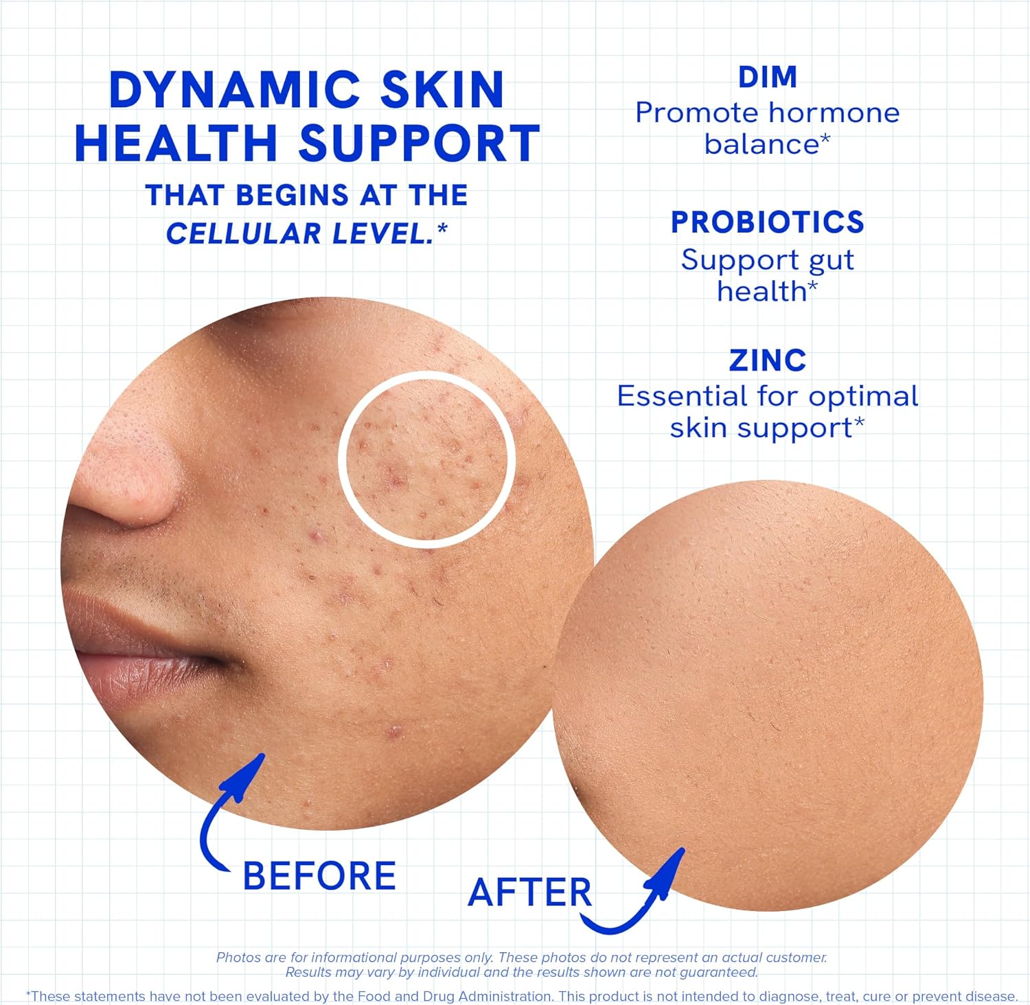 Clear Skin Acne Supplement with Zinc, DIM & Probiotics | 3-in-1 Balance, Clarify, Restore Support with Hyaluronic Acid & Skin Support Vitamins | for Women & Men | Oral Hormonal Acne Pills | 60 Ct